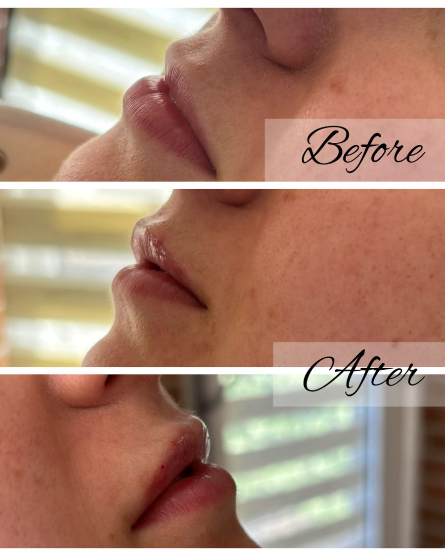 Lip flip treatment, before and after