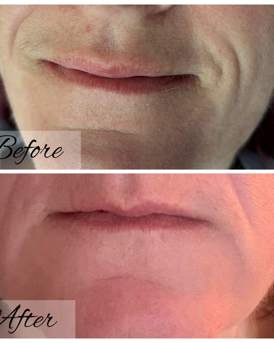 Lip flip treatment, before and after