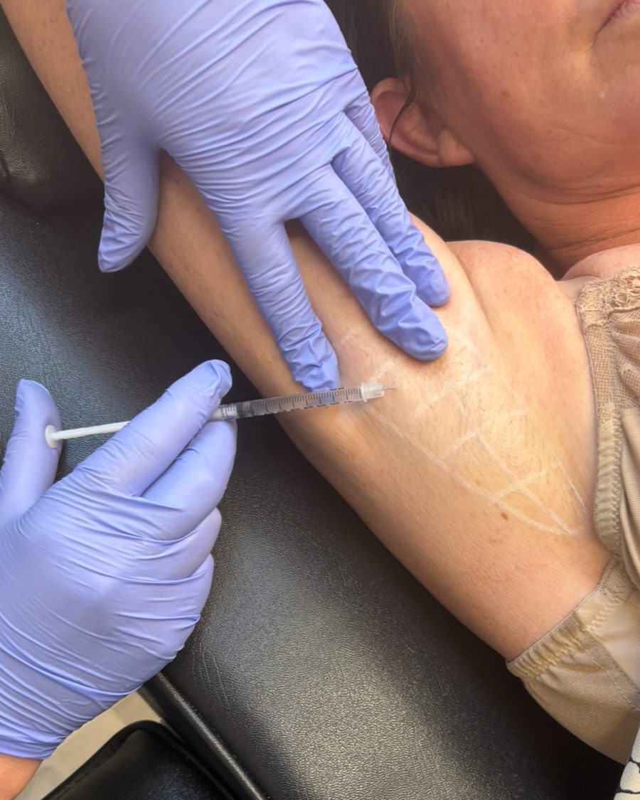 Axilla sweat area anti-wrinkle treatment being administered